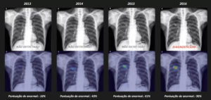 Radiografias de um paciente com câncer pulmonar aos 54 anos. Imagens fornecidas por uma instituição privada na Coreia com o uso do Lunit INSIGHT CXR