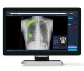 Conheça o Lunit INSIGHT CXR